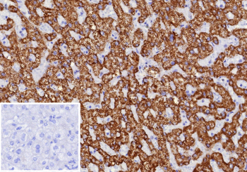 Formalin-fixed, paraffin-embedded human hepatocellular carcinoma stained with CPS1 Mouse Monoclonal Antibody (CPS1/9870). Inset: PBS instead of primary antibody; secondary only negative control.