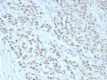 ESR1 Antibody Recombinant Mouse MAb Breast IHC. Immunohistochemistry analysis of Estrogen receptor alpha in human breast tissue. Formalin-fixed, paraffin-embedded human breast tissue was stained using recombinant ESR1/Estrogen receptor 1 antibody recombinant mouse mAb rESR1/9525, showing clear nuclear immunoreactivity in epithelial cells consistent with Estrogen receptor 1 expression. Heat-induced epitope retrieval was performed by heating tissue sections in 10 mM Tris with 1 mM EDTA, pH 9.0, at 95oC for 45 minutes, followed by cooling at room temperature for 20 minutes prior to immunostaining.