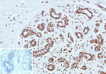 Immunohistochemistry analysis of Estrogen receptor beta in human breast carcinoma tissue. Formalin-fixed, paraffin-embedded human breast carcinoma tissue was stained using Estrogen receptor beta/ER beta antibody (clone ESR2/9709), showing nuclear immunoreactivity in tumor epithelial cells consistent with Estrogen receptor beta expression encoded by the ESR2 gene. Heat-induced epitope retrieval was performed by heating tissue sections in 10 mM Tris with 1 mM EDTA, pH 9.0, at 95oC for 45 minutes, followed by cooling at room temperature for 20 minutes. Inset shows PBS substituted for the primary antibody as a secondary-only negative control.