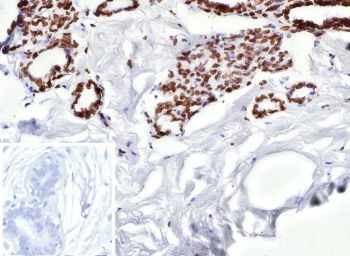 ER beta Antibody Breast Carcinoma IHC. Immunohistochemistry analysis of Estrogen receptor beta 2 in human breast carcinoma. Formalin-fixed, paraffin-embedded human breast carcinoma tissue was stained with ER beta/Estrogen receptor beta antibody (clone ESR2/9710), showing nuclear staining in tumor epithelial cells, with surrounding stromal cells largely negative. Hematoxylin was used as a nuclear counterstain. Inset shows a negative control section processed with PBS instead of the primary antibody, followed by secondary antibody only. Staining of formalin-fixed tissues required heating tissue sections in 10mM Tris with 1mM EDTA, pH 9.0, for 45 min at 95oC followed by cooling at room temperature.