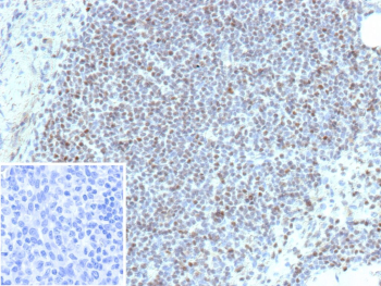 ETS1 Antibody Lymph Node IHC. Immunohistochemistry of FFPE human lymph node tissue using ETS1 antibody shows strong HRP-DAB brown nuclear staining in lymphoid cells, consistent with ETS1 function as a transcriptional regulator in immune cell populations and supporting its role in transcriptional regulation within the lymphoid microenvironment; inset shows a negative control section processed with PBS instead of primary antibody, confirming minimal non-specific staining. Detection was performed with clone r1G11. HIER: heat tissue sections in 10mM Tris with 1mM EDTA, pH 9.0, for 45 min at 95oC followed by cooling at room temperature.