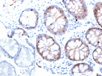Intestinal fatty acid-binding protein Antibody Colon IHC. Immunohistochemistry of FABP2 in human colon tissue. Formalin-fixed, paraffin-embedded human colon tissue was stained with Intestinal fatty acid-binding protein/I-FABP antibody (clone FABP2/6936). Brown chromogenic signal indicates FABP2-positive epithelial cells within colonic glands, with staining localized to the cytoplasmic compartment of glandular epithelial cells. Inset shows PBS used in place of the primary antibody as a secondary-only negative control. Staining of formalin-fixed tissues required heating tissue sections in 10mM Tris with 1mM EDTA, pH 9.0, for 45 min at 95oC followed by cooling at room temperature for 20 minutes.