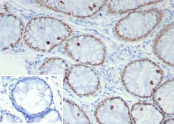 Immunohistochemistry analysis of SATB2 in human colon tissue. Formalin-fixed, paraffin-embedded human colon tissue stained with SATB2 antibody mouse monoclonal SATB2/7489. Nuclear brown chromogenic staining is observed in colonic epithelial cells, consistent with SATB2-positive nuclei. Inset shows PBS instead of primary antibody as a secondary-only negative control. Staining of formalin-fixed tissues requires heating tissue sections in 10mM Tris with 1mM EDTA, pH 9.0, for 45 min at 95oC followed by cooling at RT for 20 minutes.