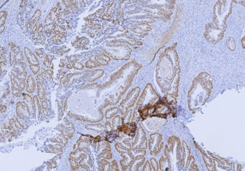 SATB2 Transcription Factor Antibody Colon Carcinoma IHC. Immunohistochemistry analysis of SATB2 in human colon carcinoma. Formalin-fixed, paraffin-embedded human colon carcinoma tissue shows strong nuclear brown chromogenic staining in tumor epithelial cells using recombinant SATB2 Transcription Factor antibody (clone SATB2/9432R), consistent with nuclear localization of the SATB2 transcription factor in colorectal carcinoma cells. Staining of formalin-fixed tissues requires heating tissue sections in 10mM Tris with 1mM EDTA, pH 9.0, for 45 min at 95oC followed by cooling at RT for 20 minutes.