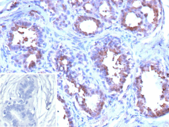 GSTP1 Antibody Breast Carcinoma Cytoplasmic IHC. Immunohistochemistry analysis of GSTP1 expression in FFPE human breast carcinoma using GSTP1 antibody clone GSTP1/12956R. Tumor epithelial cells show strong HRP-DAB brown cytoplasmic staining, while surrounding stromal cells display minimal signal. An inset negative control using PBS in place of primary antibody shows no specific staining, confirming low background and assay specificity. Heat induced epitope retrieval was performed using appropriate buffer conditions prior to staining.