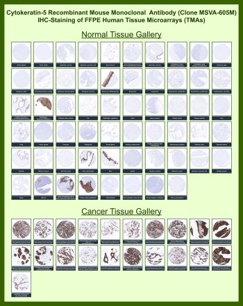 KRT5 Antibody for IHC Tissue Microarray (TMA). Immunohistochemistry analysis of Cytokeratin 5 (KRT5) expression in FFPE human tissue microarray sections using KRT5 Antibody for IHC clone MSVA-605M. Tissue microarray panels containing a wide range of normal and cancer tissues demonstrate strong cytoplasmic HRP-DAB brown staining in basal epithelial cell layers of stratified epithelia, including skin, esophagus, and urothelium, while stromal, mesenchymal, and most luminal epithelial compartments remain negative. In cancer TMAs, robust staining is observed in squamous cell carcinomas and tumors with basal-like differentiation, whereas adenocarcinomas and non-epithelial malignancies show minimal to absent signal. The consistent basal-restricted staining pattern across large-scale TMA cohorts supports Cytokeratin 5 as a reliable basal epithelial marker and highlights the utility of this immunohistochemistry antibody for distinguishing squamous and basal-type tumors in FFPE tissue analysis.
