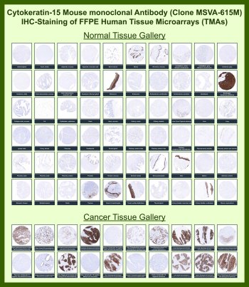 KRT15 Antibody for IHC Tissue Microarray (TMA). Immunohistochemistry analysis of Keratin 15 KRT15 in formalin-fixed paraffin-embedded human normal and cancer tissue microarrays using recombinant mouse monoclonal KRT15 antibody clone MSVA-615M. Tissue microarray (TMA) staining with HRP-DAB brown chromogen demonstrates cytoplasmic localization restricted to basal epithelial cell populations, including epidermal basal keratinocytes, basal layers of tonsillar and esophageal squamous epithelium, prostate basal cells, and urothelial basal compartments, while suprabasal epithelial layers and most non-epithelial tissues show minimal to no signal. Within tumor tissue microarrays, strong staining is observed in squamous cell carcinomas, with limited reactivity in non-squamous malignancies, supporting its role as a basal and progenitor-associated epithelial marker. Evaluation across large TMA panels enables direct comparison of KRT15 expression across diverse tissue types under standardized conditions. The observed staining patterns align with reported KRT15 expression profiles in publicly available datasets including the Human Protein Atlas.