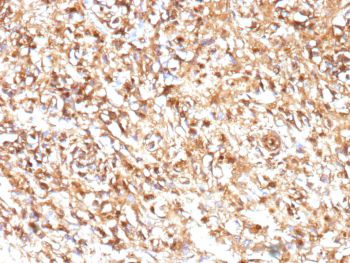 IHC staining of FFPE human Ewing sarcoma tissue with recombinant MIC2/CD99 antibody (clone MIC2/9939R). Tumor cells show strong diffuse membranous staining. HIER: boil tissue sections in pH 9 10mM Tris with 1mM EDTA for 45 min at 95oC followed by cooling at RT for 20 minutes.