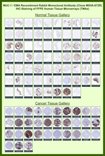 MUC1 Antibody for IHC Tissue Microarray (TMA). Immunohistochemistry analysis of Mucin 1 MUC1, also known as Epithelial membrane antigen, in formalin-fixed paraffin-embedded human normal and cancer tissue microarrays using recombinant rabbit monoclonal MUC1 antibody clone MSVA-672R. Tissue microarray (TMA) staining with HRP-DAB brown chromogen demonstrates prominent membranous and cytoplasmic localization in glandular and ductal epithelial tissues, consistent with luminal surface expression, while non-epithelial tissues including stromal and mesenchymal compartments show minimal to absent staining. Within tumor tissue microarrays, strong and often diffuse staining is observed in epithelial-derived malignancies, supporting identification of carcinoma cells and altered epithelial polarity. Evaluation across large TMA panels enables direct comparison of MUC1 expression across diverse tissue types under standardized conditions. The observed staining patterns align with reported MUC1 expression profiles in publicly available datasets including the Human Protein Atlas.