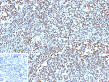 Immunohistochemistry analysis of Transcriptional Corepressor BCOR antibody in human tonsil tissue. Formalin-fixed, paraffin-embedded human tonsil stained with BCOR Recombinant Rabbit Monoclonal Antibody (clone BCOR/13087R) demonstrates predominant nuclear HRP-DAB brown staining in lymphoid cells within germinal center and interfollicular regions, consistent with the known nuclear localization of BCL-6 corepressor. Background stromal elements show minimal staining. The inset image represents the negative control in which PBS was used instead of the primary antibody, confirming absence of non-specific secondary antibody binding. Heat-induced epitope retrieval was performed by boiling tissue sections in pH 9, 10mM Tris with 1mM EDTA for 45 minutes at 95oC followed by cooling prior to immunostaining.