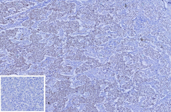 Immunohistochemistry analysis of ZNF797 / Spalt-like transcription factor 4 antibody (clone SALL4/12615) in human seminoma. FFPE human seminoma tissue shows strong nuclear brown chromogenic staining in tumor cells, consistent with the expected nuclear localization of this transcription factor. The staining is diffuse within the seminoma cell population, with minimal background in surrounding stromal elements. Heat induced epitope retrieval was performed by boiling sections in 10mM Tris with 1mM EDTA, pH 9.0, for 45 minutes at 95oC followed by cooling at RT for 20 minutes before antibody incubation.