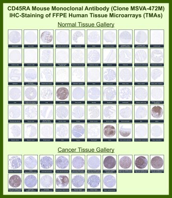CD45RA Antibody for IHC Tissue Microarray (TMA). Immunohistochemistry analysis of Protein tyrosine phosphatase receptor type C PTPRC, also known as CD45RA, in formalin-fixed paraffin-embedded human normal and cancer tissue microarrays using recombinant mouse monoclonal CD45RA antibody clone MSVA-472M. Tissue microarray (TMA) staining with HRP-DAB brown chromogen demonstrates strong membranous localization in lymphoid cell populations, prominently highlighting lymphocytes within tonsil, spleen, thymus, and lymph node, while non-hematopoietic epithelial and stromal tissues remain largely negative. Within tumor tissue microarrays, diffuse membranous positivity is observed in CD45RA-positive lymphoid malignancies, while most non-lymphoid tumors remain negative with staining restricted to infiltrating immune cells. Evaluation across large TMA panels enables direct comparison of PTPRC expression across diverse tissue types under standardized conditions. The observed staining patterns align with reported PTPRC expression profiles in publicly available datasets including the Human Protein Atlas, supporting its use for lymphoid cell identification and immune profiling.