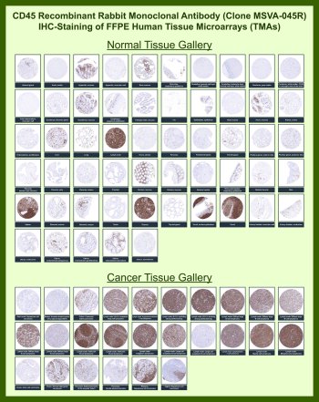 CD45 Antibody for IHC Tissue Microarray (TMA). Immunohistochemistry analysis of Protein tyrosine phosphatase receptor type C PTPRC, also known as Leukocyte common antigen CD45, in formalin-fixed paraffin-embedded human normal and cancer tissue microarrays using recombinant rabbit monoclonal CD45 antibody clone MSVA-045R. Tissue microarray (TMA) staining with HRP-DAB brown chromogen demonstrates robust membranous localization in lymphoid-rich tissues including tonsil, lymph node, spleen, and thymus, highlighting abundant leukocyte populations and normal immune architecture, while most non-hematopoietic epithelial and stromal tissues remain largely negative. Within tumor tissue microarrays, strong and diffuse staining is observed across multiple lymphoma subtypes, clearly identifying hematopoietic malignancies, whereas most non-hematologic tumors show minimal to no staining except for infiltrating immune cells within the tumor microenvironment. Evaluation across large TMA panels enables direct comparison of PTPRC expression across diverse tissue types under standardized conditions. The observed staining patterns align with reported PTPRC expression profiles in publicly available datasets including the Human Protein Atlas, supporting its use as a pan-leukocyte marker for immunohistochemistry studies.