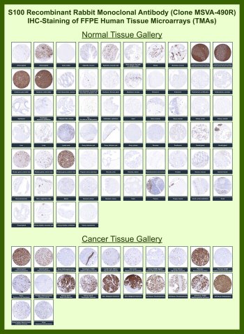 S100 Antibody for IHC Tissue Microarray (TMA). Immunohistochemistry analysis of S100 calcium binding protein B S100B in formalin-fixed paraffin-embedded human normal and cancer tissue microarrays using recombinant rabbit monoclonal S100 antibody clone MSVA-490R. Tissue microarray (TMA) staining with HRP-DAB brown chromogen demonstrates strong nuclear and cytoplasmic localization in neural and melanocytic cell populations, including astrocytes in central nervous system tissues and melanocytes in peripheral tissues, while most epithelial tissues remain largely negative. Within tumor tissue microarrays, intense and diffuse staining is observed in melanoma and selected neural and soft tissue tumors, supporting its role as a marker of neural crest-derived lineages, whereas most epithelial malignancies show minimal to absent staining aside from occasional stromal or infiltrating S100-positive cells. Evaluation across large TMA panels enables direct comparison of S100B expression across diverse tissue types under standardized conditions. The observed staining patterns align with reported S100B expression profiles in publicly available datasets including the Human Protein Atlas.