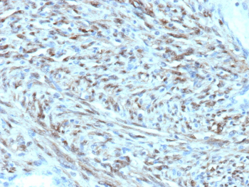 Signal Transducer 6 Antibody Liposarcoma IHC. Immunohistochemical analysis of STAT6 expression in formalin-fixed, paraffin-embedded human liposarcoma tissue using Signal Transducer 6 antibody clone STAT6/12798R. Strong nuclear HRP-DAB brown staining is observed in spindle-shaped tumor cells arranged in fascicles, consistent with activated STAT6 signaling and nuclear translocation. HIER: heating in pH 9 Tris-EDTA buffer followed by cooling prior to staining.