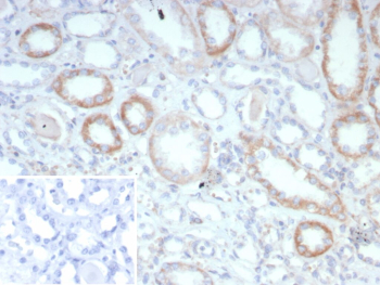 Immunohistochemistry analysis of Angiopoietin Receptor / TIE2 antibody in human renal cell carcinoma tissue (clone TEK/9412). FFPE human renal cell carcinoma sections show HRP-DAB brown membranous staining outlining tumor-associated vascular endothelial cells, with focal cytoplasmic signal in adjacent epithelial structures. The staining pattern highlights microvascular components within the tumor stroma, consistent with TEK receptor tyrosine kinase localization. Tumor epithelial cells display weaker and more variable staining compared to endothelial elements. The inset shows PBS used in place of primary antibody as a secondary antibody negative control, confirming absence of specific brown chromogenic signal. Heat induced epitope retrieval was performed in 10 mM Tris with 1 mM EDTA, pH 9.0, by heating tissue sections at 95oC for 45 minutes followed by cooling at room temperature for 20 minutes prior to antibody incubation.
