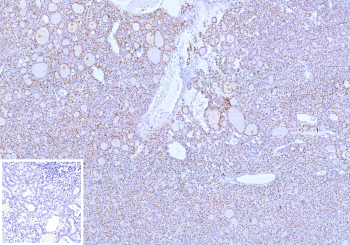 Thyroid Transcription Factor PAX8 Antibody immunohistochemistry in human thyroid tissue showing diffuse nuclear HRP-DAB brown staining in follicular epithelial cells. Paired box protein Pax-8 (PAX8) expression is localized to nuclei lining thyroid follicles, with uniform nuclear positivity surrounding colloid-filled lumina and clear preservation of follicular architecture. The staining is confined to epithelial cell nuclei with minimal signal in stromal components, while colloid material remains unstained. The nuclear pattern reflects transcriptional activity of this thyroid transcription factor and supports its role in regulating gene expression in follicular cells. Inset: negative control using PBS in place of primary antibody shows absence of specific staining. Heat-induced epitope retrieval was performed in 10mM Tris with 1mM EDTA, pH 9.0, for 45 min at 95oC followed by cooling at room temperature for 20 minutes.