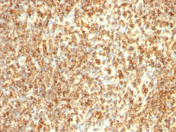 Immunohistochemistry analysis of MS4A1 Antibody / Membrane spanning 4-domains A1 in human lymphoma tissue. FFPE human lymphoma demonstrates diffuse membranous HRP-DAB brown staining in neoplastic B cells, consistent with strong CD20/MS4A1 surface expression, while background stromal elements show minimal staining. Detection was performed using mouse monoclonal antibodies (clones L26 + IGEL/773), highlighting robust B-cell lineage labeling in malignant lymphoid tissue. Antigen retrieval was performed by heating tissue sections in 10mM Tris with 1mM EDTA, pH 9.0, at 95oC for 45 minutes followed by cooling at room temperature for 20 minutes prior to incubation with CD20 antibody.