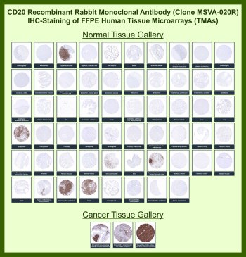 CD20 Antibody for IHC Tissue Microarray (TMA). Immunohistochemistry analysis of CD20 molecule MS4A1 in formalin-fixed paraffin-embedded human normal and cancer tissue microarrays using recombinant rabbit monoclonal CD20 antibody clone MSVA-020R. Tissue microarray (TMA) staining with HRP-DAB brown chromogen demonstrates strong membranous localization in B lymphocyte populations within tonsil, lymph node, and spleen, while non-lymphoid epithelial and stromal tissues remain largely negative. Within tumor tissue microarrays, diffuse membranous staining is observed in B cell lymphomas, enabling clear identification of B cell lineage malignancies, whereas most non-hematologic tumors show minimal to no staining. Evaluation across large TMA panels enables direct comparison of MS4A1 expression across diverse tissue types under standardized conditions. The observed staining patterns align with reported CD20 expression profiles in the Human Protein Atlas, supporting reliable detection of B lymphocytes and lymphoma characterization.