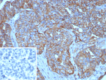 Immunohistochemistry analysis of CA125 Antibody (Clone CA125/8894) in FFPE human ovarian carcinoma tissue. Strong membranous and apical cytoplasmic HRP-DAB brown staining is observed in malignant epithelial cells forming glandular structures, consistent with overexpression of MUC16 / Cancer antigen 125 in ovarian carcinoma, while surrounding stromal elements are largely negative. Clone CA125/8894 demonstrates distinct epithelial surface localization. The inset shows PBS used in place of the primary antibody as a secondary-only negative control. Heat-induced epitope retrieval was performed in 10mM Tris with 1mM EDTA, pH 9.0, at 95oC for 45 minutes followed by cooling at room temperature for 20 minutes.