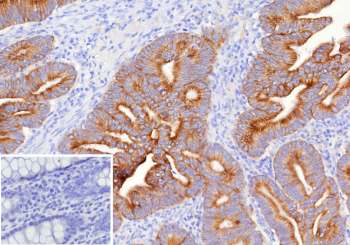 Immunohistochemistry analysis of CA125 Antibody (Clone CA125/8894) in FFPE human colon carcinoma tissue. Distinct membranous and apical cytoplasmic HRP-DAB brown staining is observed in malignant gland-forming epithelial cells, consistent with MUC16 / Cancer antigen 125 expression in colon carcinoma, while adjacent stromal cells are largely negative. The inset shows absence of staining in negative control tissue. Heat-induced epitope retrieval was performed in 10mM Tris with 1mM EDTA, pH 9.0, at 95oC for 45 minutes followed by cooling at room temperature for 20 minutes.