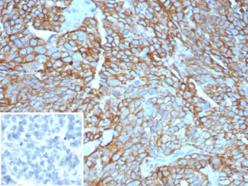 Immunohistochemistry analysis of Cancer antigen 125 Antibody (Clone CA125/8893) in FFPE human ovarian carcinoma tissue. Strong membranous and apical cytoplasmic HRP-DAB brown staining is observed in malignant epithelial cells forming solid and glandular structures, consistent with overexpression of MUC16 / CA125 in ovarian carcinoma, while surrounding stromal elements are largely negative. The inset shows PBS used in place of the primary antibody as a secondary-only negative control. Heat-induced epitope retrieval was performed in 10mM Tris with 1mM EDTA, pH 9.0, at 95oC for 45 minutes followed by cooling at room temperature for 20 minutes.