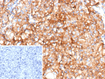 Immunohistochemistry of CD70 Molecule Antibody in human renal cell carcinoma tissue. FFPE renal cell carcinoma shows strong membranous HRP-DAB brown staining in tumor epithelial cells, consistent with CD70 expression in malignant cells. Clone CD70/12768R was used for detection. Heat-induced epitope retrieval was performed by heating tissue sections in 10 mM Tris with 1 mM EDTA, pH 9.0, at 95oC for 45 minutes followed by cooling at room temperature for 20 minutes. Inset shows PBS used in place of primary antibody as a secondary-only negative control.