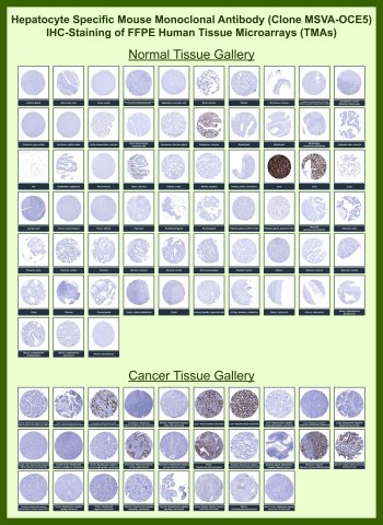 Hepatocyte Antibody for IHC Tissue Microarray (TMA). Immunohistochemistry analysis of hepatocyte differentiation marker expression in formalin-fixed paraffin-embedded human normal and cancer tissue microarrays using recombinant mouse monoclonal hepatocyte antibody clone MSVA-OCE5. Tissue microarray (TMA) staining with HRP-DAB brown chromogen demonstrates strong cytoplasmic localization in normal liver hepatocytes with uniform labeling across hepatic cores, while non-hepatic tissues show minimal to absent staining, supporting high specificity. Within tumor tissue microarrays, robust staining is observed in hepatocellular carcinoma, whereas most non-hepatic malignancies demonstrate little to no reactivity, providing clear contrast for determining tumor origin. Evaluation across large TMA panels enables direct comparison of hepatocyte marker expression across diverse tissue types under standardized conditions. The observed staining patterns align with reported hepatocyte-specific expression profiles in the Human Protein Atlas.