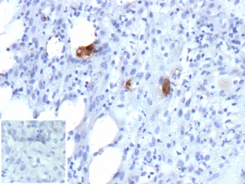 Immunohistochemistry of UL83 antibody in human CMV-infected tissue. FFPE human cytomegalovirus-infected tissue shows focal cytoplasmic HRP-DAB brown staining in scattered infected cells, consistent with Major Tegument Protein / pp65 expression in virally infected cells. Clone r2, a recombinant mouse monoclonal antibody, was used for detection. An inset image shows PBS substituted for the primary antibody as a negative control, confirming absence of specific staining. Heat-induced epitope retrieval was performed by heating sections in 10 mM Tris with 1 mM EDTA, pH 9.0, for 45 minutes at 95oC followed by cooling at room temperature for 20 minutes prior to staining.