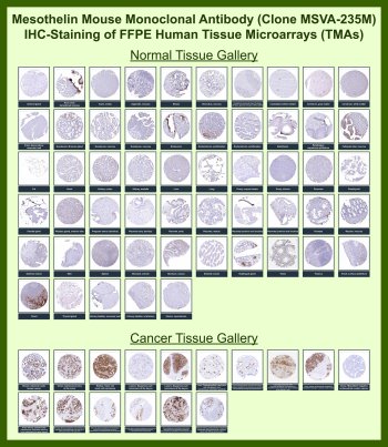 Mesothelin Antibody for IHC Tissue Microarray (TMA). Immunohistochemistry analysis of Mesothelin MSLN in formalin-fixed paraffin-embedded human normal and cancer tissue microarrays using recombinant mouse monoclonal Mesothelin antibody clone MSVA-235M. Tissue microarray (TMA) staining with HRP-DAB brown chromogen demonstrates distinct membranous and cytoplasmic localization in mesothelin-positive tumors, including ovarian, pancreatic, and mesothelioma-derived tissues, while most normal tissues show minimal to absent staining consistent with restricted mesothelial expression. Within tumor tissue microarrays, this differential staining pattern provides clear contrast between mesothelin-expressing malignancies and non-expressing tissues, supporting tumor classification and comparative analysis. Evaluation across large TMA panels enables direct comparison of MSLN expression across diverse tissue types under standardized conditions. The observed staining patterns align with reported MSLN expression profiles in the Human Protein Atlas.