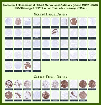 CNN1 Antibody Tissue Microarray (TMA) IHC. Immunohistochemistry analysis of Calponin 1 / CNN1 in FFPE human normal and cancer tissue microarrays using CNN1 Antibody for IHC clone MSVA-455R, a marker of smooth muscle tissue architecture. Tissue microarray staining with HRP-DAB brown chromogen shows strong cytoplasmic signal in smooth muscle cell populations, including vascular walls and gastrointestinal muscular layers, as well as myoepithelial cells in select glandular tissues, while most non-smooth muscle tissues display minimal staining. In cancer tissue arrays, robust positivity is observed in smooth muscle tumors such as leiomyoma and leiomyosarcoma, whereas non-mesenchymal malignancies are largely negative. Evaluation across TMA panels enables direct comparison of CNN1 expression across diverse tissue types under standardized conditions.