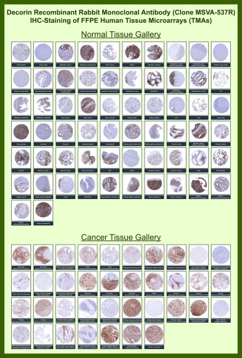 Decorin Antibody for IHC Tissue Microarray (TMA). Immunohistochemistry analysis of Decorin DCN in formalin-fixed paraffin-embedded human normal and cancer tissue microarrays using recombinant rabbit monoclonal Decorin antibody clone MSVA-537R. Tissue microarray (TMA) staining with HRP-DAB brown chromogen demonstrates predominant localization within stromal extracellular matrix compartments, highlighting collagen-rich connective tissue surrounding glands, vessels, and muscle bundles, while epithelial and parenchymal cells remain largely negative. Within tumor tissue microarrays, variable stromal staining intensity is observed in tumor-associated connective tissue, consistent with extracellular matrix remodeling. Evaluation across large TMA panels enables direct comparison of Decorin expression across diverse tissue types under standardized conditions. The observed staining patterns align with reported DCN expression profiles in the Human Protein Atlas, supporting its use in extracellular matrix and stromal biology studies.