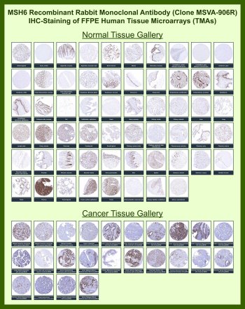 MSH6 Antibody for IHC Tissue Microarray (TMA). Immunohistochemistry analysis of MutS homolog 6 / MSH6 in formalin-fixed paraffin-embedded human normal and cancer tissue microarrays using rabbit monoclonal antibody clone MSVA-906R. Tissue microarray (TMA) staining with HRP-DAB brown chromogen demonstrates nuclear localization in proliferating epithelial and lymphoid cell populations across multiple tissue types, consistent with the role of MSH6 in the DNA mismatch repair pathway. In normal tissue microarrays, strong nuclear labeling is observed in cells with active DNA replication, while stromal or quiescent cell populations show weaker or absent staining. Within tumor tissue microarrays, variable nuclear staining intensity is detected among tumor epithelial cells, reflecting differences in mismatch repair status. Evaluation across large TMA panels enables direct comparison of MSH6 expression across diverse tissue types under standardized conditions. The observed staining patterns align with reported MSH6 expression profiles in the Human Protein Atlas and support its use as a marker of DNA mismatch repair activity.