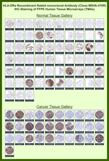 HLA-DRA Antibody for IHC Tissue Microarray (TMA). Immunohistochemistry analysis of Human leukocyte antigen DR alpha / HLA-DRA in formalin-fixed paraffin-embedded human normal and cancer tissue microarrays using recombinant rabbit monoclonal antibody clone MSVA-470R. Tissue microarray (TMA) staining with HRP-DAB brown chromogen demonstrates predominant membranous and cytoplasmic localization in antigen-presenting immune cells, including lymphocytes, macrophages, and dendritic cells across multiple tissues, while most non-immune cell populations show minimal to absent staining. Within tumor tissue microarrays, positive staining highlights infiltrating immune cells within the tumor microenvironment. Evaluation across large TMA panels enables direct comparison of HLA-DRA expression across diverse tissue types under standardized conditions. The observed staining patterns align with reported HLA-DR alpha expression profiles in the Human Protein Atlas and support its role in MHC class II antigen presentation.