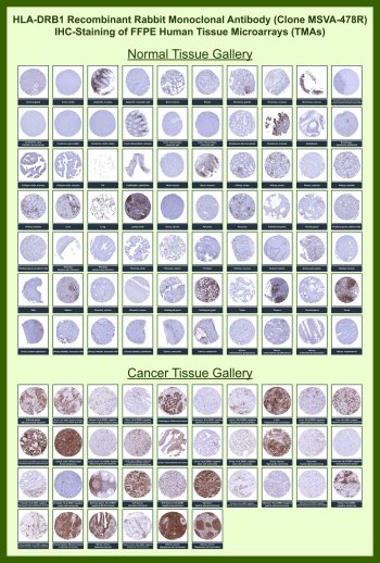 HLA-DRB1 Antibody for IHC Tissue Microarray (TMA). Immunohistochemistry analysis of HLA-DR beta chain / HLA-DRB1 in formalin-fixed paraffin-embedded human normal and cancer tissue microarrays using rabbit monoclonal antibody clone MSVA-478R. Tissue microarray (TMA) staining with HRP-DAB brown chromogen demonstrates strong membranous localization in antigen-presenting immune cells, including B lymphocytes, dendritic cells, and macrophages. Prominent staining is observed in lymphoid tissues such as tonsil, lymph node, and spleen, while most epithelial and stromal cell populations remain largely negative. Within tumor tissue microarrays, positive staining highlights infiltrating immune cell populations within the tumor microenvironment. Evaluation across large TMA panels enables direct comparison of HLA-DRB1 expression across diverse tissue types under standardized conditions. The observed staining patterns align with reported expression profiles in the Human Protein Atlas and support its role in MHC class II antigen presentation.