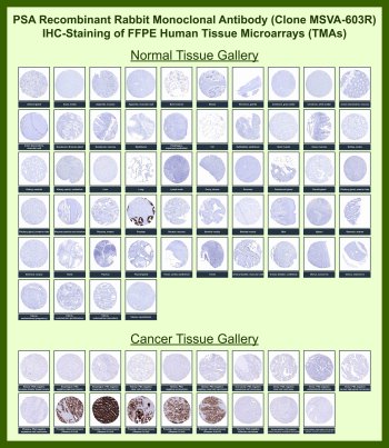 PSA Antibody for IHC Tissue Microarray (TMA). Immunohistochemistry analysis of Prostate specific antigen / KLK3 in formalin-fixed paraffin-embedded human normal and cancer tissue microarrays using rabbit monoclonal antibody clone MSVA-603R. Tissue microarray (TMA) staining with HRP-DAB brown chromogen demonstrates strong cytoplasmic and luminal localization in prostate epithelial cells of normal prostate tissue, while most other normal tissues show minimal to absent staining. Within tumor tissue microarrays, strong PSA expression is observed in prostate adenocarcinoma, whereas non-prostatic tumors are largely negative. Evaluation across large TMA panels enables direct comparison of KLK3 expression across diverse tissue types under standardized conditions. The observed staining patterns align with reported PSA expression profiles in the Human Protein Atlas and support its use as a marker of prostatic epithelial differentiation.