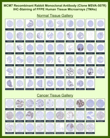 MCM7 Antibody for IHC Tissue Microarray (TMA). Immunohistochemistry analysis of Minichromosome maintenance protein 7 / MCM7 in formalin-fixed paraffin-embedded human normal and cancer tissue microarrays using recombinant rabbit monoclonal antibody clone MSVA-507R. Tissue microarray (TMA) staining with HRP-DAB brown chromogen demonstrates strong nuclear localization in proliferating cell populations across multiple tissues, including germinal center lymphocytes in tonsil and lymph node, intestinal epithelial cells in colon and appendix mucosa, proliferative compartments of the endometrium, and subsets of epithelial cells in testis and bronchial mucosa, while differentiated tissues such as skeletal muscle, cardiac muscle, and mature stromal compartments show minimal to absent staining. Within tumor tissue microarrays, strong nuclear staining is observed across multiple malignancies including colorectal carcinoma, breast carcinoma, lung carcinoma, and lymphoid neoplasms, reflecting elevated DNA replication activity in proliferating tumor cells. Evaluation across large TMA panels enables direct comparison of MCM7 expression across diverse tissue types under standardized conditions. The observed staining patterns align with reported expression profiles in the Human Protein Atlas and support its use as a marker of cellular proliferation and DNA replication activity.