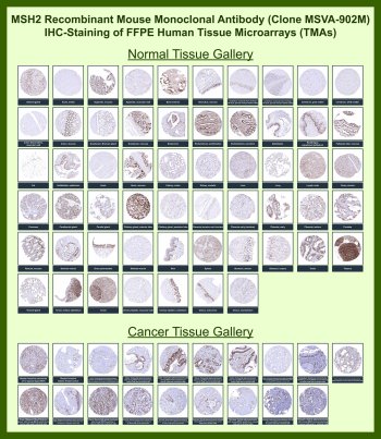 MSH2 Antibody for IHC Tissue Microarray (TMA). Immunohistochemistry analysis of MutS homolog 2 / MSH2 in formalin-fixed paraffin-embedded human normal and cancer tissue microarrays using mouse monoclonal antibody clone MSVA-902M. Tissue microarray (TMA) staining with HRP-DAB brown chromogen demonstrates nuclear localization in cells with intact DNA mismatch repair activity across multiple tissue types, while stromal and quiescent cell populations may show reduced or absent staining. Within tumor tissue microarrays, nuclear staining patterns provide reference for mismatch repair status, with variable expression observed among different malignancies. Evaluation across large TMA panels enables direct comparison of MSH2 expression across diverse tissue types under standardized conditions. The observed staining patterns align with reported expression profiles in the Human Protein Atlas and support its use as a marker of DNA mismatch repair function.