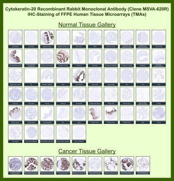 KRT20 Antibody for IHC Tissue Microarray (TMA). Immunohistochemistry analysis of Keratin 20 KRT20, also known as Cytokeratin 20, across formalin-fixed paraffin-embedded human normal and cancer tissue microarrays using recombinant rabbit monoclonal KRT20 antibody clone MSVA-620R. Tissue microarray (TMA) staining with HRP-DAB brown chromogen highlights cytoplasmic expression in gastrointestinal epithelial cells, including strong staining of colonic and rectal mucosa, while most non-epithelial tissues remain negative. Within tumor tissue microarrays, positive staining is observed in epithelial-derived cancers, consistent with the known distribution of this intermediate filament protein. The observed TMA staining patterns across a wide range of tissues align with reported KRT20 expression profiles in the Human Protein Atlas.