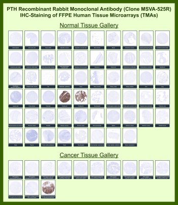 Parathyroid Hormone Antibody for IHC Tissue Microarray (TMA). Immunohistochemistry analysis of Parathyroid hormone / PTH in formalin-fixed paraffin-embedded human normal and cancer tissue microarrays using rabbit monoclonal antibody clone MSVA-525R. Tissue microarray (TMA) staining with HRP-DAB brown chromogen demonstrates strong cytoplasmic localization in parathyroid gland tissue, specifically in endocrine chief cells responsible for calcium homeostasis, while most other normal tissues and tumor types show minimal to absent staining. Within tumor tissue microarrays, staining is generally absent in non-parathyroid malignancies, reflecting the highly restricted expression pattern of PTH. Evaluation across large TMA panels enables direct comparison of PTH expression across diverse tissue types under standardized conditions. The observed staining patterns align with reported Parathyroid hormone expression profiles in the Human Protein Atlas and support its use as a marker of parathyroid tissue and endocrine differentiation.