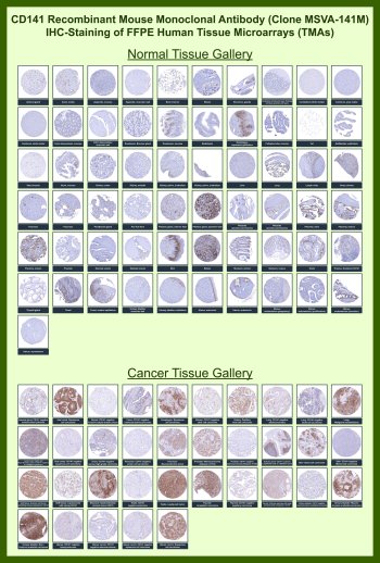 THBD Antibody for IHC Tissue Microarray (TMA). Immunohistochemistry analysis of Thrombomodulin / THBD in formalin-fixed paraffin-embedded human normal and cancer tissue microarrays using mouse monoclonal antibody clone MSVA-141M. Tissue microarray (TMA) staining with HRP-DAB brown chromogen demonstrates membranous localization in vascular endothelial cells, highlighting capillaries and blood vessel linings across diverse organs, while most non-endothelial cell populations remain largely negative. Within tumor tissue microarrays, staining highlights tumor-associated vasculature with variable endothelial expression across different malignancies. Evaluation across large TMA panels enables direct comparison of THBD expression across diverse tissue types under standardized conditions. The observed staining patterns align with reported Thrombomodulin expression profiles in the Human Protein Atlas and support its use as a marker of vascular endothelium and tumor-associated angiogenesis.
