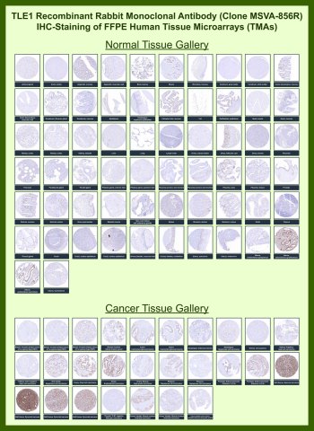 TLE1 Antibody for IHC Tissue Microarray (TMA). Immunohistochemistry analysis of Transducin-like enhancer protein 1 TLE1 in formalin-fixed paraffin-embedded human normal and cancer tissue microarrays using recombinant rabbit monoclonal TLE1 antibody clone MSVA-856R. Tissue microarray (TMA) staining with HRP-DAB brown chromogen demonstrates nuclear localization consistent with the function of TLE1 as a transcriptional corepressor. Within tumor tissue microarrays, strong nuclear staining is observed in synovial sarcoma samples, supporting its established use as an immunohistochemistry marker for synovial sarcoma and related soft tissue tumors, while most normal tissues show absent or minimal nuclear signal. Evaluation across large TMA panels enables direct comparison of TLE1 expression across diverse tissue types under standardized conditions, with variable expression observed in selected epithelial and tumor tissues. The observed staining patterns align with reported TLE1 expression profiles in large-scale datasets including the Human Protein Atlas.