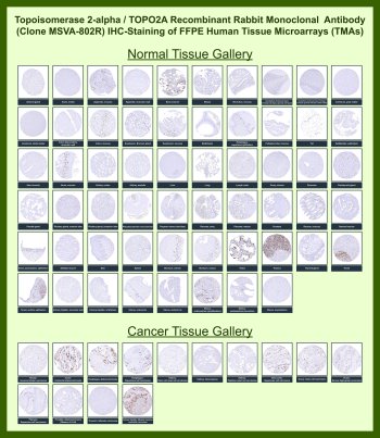 TOP2A Antibody for IHC Tissue Microarray (TMA). Immunohistochemistry analysis of DNA topoisomerase II alpha TOP2A in formalin-fixed paraffin-embedded human normal and cancer tissue microarrays using recombinant rabbit monoclonal TOP2A antibody clone MSVA-802R. Tissue microarray (TMA) staining with HRP-DAB brown chromogen demonstrates nuclear localization in proliferating cell populations, consistent with the role of TOP2A in DNA replication and chromosome segregation. Within tumor tissue microarrays, strong nuclear staining is observed in multiple malignancies including colorectal adenocarcinoma, esophageal carcinoma, squamous cell carcinoma, and urothelial carcinoma, while most normal tissues show minimal staining except in physiologically proliferating compartments. Evaluation across large TMA panels enables direct comparison of TOP2A expression across diverse tissue types under standardized conditions. The observed staining patterns align with reported TOP2A expression profiles in the Human Protein Atlas.