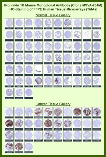 Uroplakin 1B Antibody for IHC Tissue Microarray (TMA). Immunohistochemistry analysis of Uroplakin 1B UPK1B in formalin-fixed paraffin-embedded human normal and cancer tissue microarrays using recombinant mouse monoclonal Uroplakin 1B antibody clone MSVA-734M. Tissue microarray (TMA) staining with HRP-DAB brown chromogen demonstrates membranous localization in urothelial cell populations, with strong signal observed in urothelial tissues and urothelial carcinoma samples, while most non-urothelial tissues show minimal staining. This selective staining pattern supports the role of UPK1B as a urothelial differentiation marker and enables clear identification of urothelial-derived cells in tissue sections. Evaluation across large TMA panels allows direct comparison of UPK1B expression across diverse tissue types under standardized conditions. The observed staining patterns align with reported UPK1B expression profiles in the Human Protein Atlas.