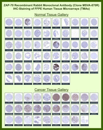 ZAP70 Antibody for IHC Tissue Microarray (TMA). Immunohistochemistry analysis of Tyrosine-protein kinase ZAP70 in formalin-fixed paraffin-embedded human normal and cancer tissue microarrays using recombinant rabbit monoclonal ZAP70 antibody clone MSVA-870R. Tissue microarray (TMA) staining with HRP-DAB brown chromogen demonstrates predominantly cytoplasmic localization in lymphoid cell populations, with strong signal observed in tonsil, thymus, and lymph node, while most non-lymphoid tissues show minimal or absent staining. Within tumor tissue microarrays, positive staining highlights tumor-infiltrating lymphocytes and cells associated with lymphoid malignancies, supporting its role as a lymphoid tissue marker and indicator of immune cell distribution. Evaluation across large TMA panels enables comparative analysis of ZAP70 expression across diverse tissue types under standardized conditions. The observed staining patterns align with reported ZAP70 expression profiles in publicly available datasets including the Human Protein Atlas.