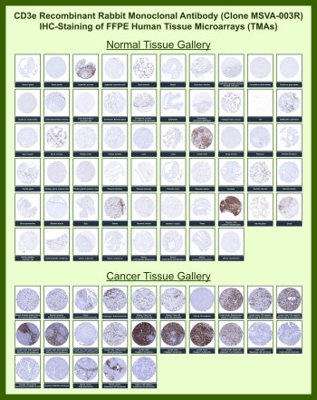 CD3e Antibody for IHC Tissue Microarray (TMA). Immunohistochemistry analysis of CD3 epsilon chain / CD3E in formalin-fixed paraffin-embedded human normal and cancer tissue microarrays using recombinant rabbit monoclonal CD3e antibody clone MSVA-003R. Tissue microarray (TMA) staining with HRP-DAB brown chromogen demonstrates membranous and cytoplasmic localization in T lymphocyte populations, with strong signal observed in lymphoid tissues such as tonsil and lymph node, highlighting interfollicular and paracortical T-cell zones, while non-lymphoid parenchymal cells remain largely negative. Within tumor tissue microarrays, variable densities of tumor-infiltrating T lymphocytes are detected within stromal compartments and at invasive margins, supporting its use as a pan-T cell marker for evaluating immune infiltration. Evaluation across large TMA panels enables direct comparison of CD3E expression across diverse tissue types under standardized conditions. The observed staining patterns align with reported CD3E expression profiles in the Human Protein Atlas.