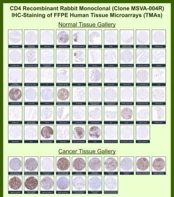 CD4 Antibody for IHC Tissue Microarray (TMA). Immunohistochemistry analysis of CD4 molecule / CD4 in formalin-fixed paraffin-embedded human normal and cancer tissue microarrays using recombinant rabbit monoclonal CD4 antibody. Tissue microarray (TMA) staining with HRP-DAB brown chromogen demonstrates membranous localization in CD4-positive T lymphocyte populations, with strong signal observed in lymphoid tissues and scattered immune cells across multiple organs, while non-immune cell types remain largely negative. Within tumor tissue microarrays, variable densities of CD4-positive T helper cells are detected in tumor microenvironments, including lymphomas and carcinomas, supporting evaluation of immune infiltration and tumor-associated lymphocyte populations. Evaluation across large TMA panels enables direct comparison of CD4 expression across diverse tissue types under standardized conditions. The observed staining patterns align with reported CD4 expression profiles in the Human Protein Atlas.