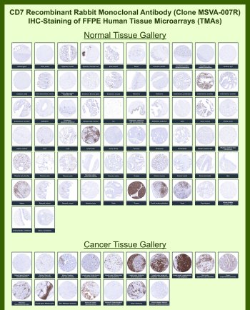 CD7 Antibody for IHC Tissue Microarray (TMA). Immunohistochemistry analysis of CD7 molecule / CD7, also known as T-cell antigen CD7, in formalin-fixed paraffin-embedded human normal and cancer tissue microarrays using recombinant rabbit monoclonal CD7 antibody clone MSVA-007R. Tissue microarray (TMA) staining with HRP-DAB brown chromogen demonstrates selective membranous localization in T lymphocyte populations within lymphoid-rich regions, including tonsil, lymph node, and thymus, while most non-lymphoid tissues remain largely negative. Within tumor tissue microarrays, staining highlights T cell populations and tumor-infiltrating lymphocytes, supporting evaluation of immune cell distribution in the tumor microenvironment. Evaluation across large TMA panels enables direct comparison of CD7 expression across diverse tissue types under standardized conditions. The observed staining patterns align with reported CD7 expression profiles in publicly available datasets including the Human Protein Atlas.