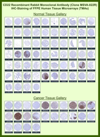 CD22 Antibody for IHC Tissue Microarray (TMA). Immunohistochemistry analysis of CD22 molecule / CD22, also known as Siglec-2, in formalin-fixed paraffin-embedded human normal and cancer tissue microarrays using recombinant rabbit monoclonal CD22 antibody clone MSVA-022R. Tissue microarray (TMA) staining with HRP-DAB brown chromogen demonstrates membranous and cytoplasmic localization in B lymphocyte populations, with strong signal observed in lymph node germinal centers, tonsil, and splenic white pulp, while most non-lymphoid tissues remain largely negative. Within tumor tissue microarrays, robust staining is observed in B cell lymphomas, including diffuse large B-cell lymphoma and follicular lymphoma, with clear distinction from surrounding stromal and epithelial compartments. Evaluation across large TMA panels enables direct comparison of CD22 expression across diverse tissue types under standardized conditions. The observed staining patterns align with reported CD22 expression profiles in publicly available datasets including the Human Protein Atlas.
