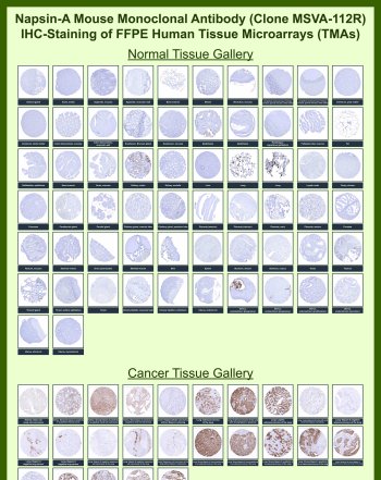 NAPSA Antibody for IHC Tissue Microarray (TMA). Immunohistochemistry analysis of Napsin A / NAPSA in formalin-fixed paraffin-embedded human normal and cancer tissue microarrays using recombinant rabbit monoclonal NAPSA antibody clone MSVA-112R. Tissue microarray (TMA) staining with HRP-DAB brown chromogen demonstrates highly restricted cytoplasmic localization in lung alveolar epithelial cells, while most non-pulmonary tissues remain largely negative. Within tumor tissue microarrays, strong and diffuse cytoplasmic staining is observed in lung adenocarcinoma samples, supporting its role as a pulmonary epithelial marker and its utility in lung cancer classification. Evaluation across large TMA panels enables direct comparison of NAPSA expression across diverse tissue types under standardized conditions. The observed staining patterns align with reported NAPSA expression profiles in the Human Protein Atlas.